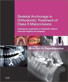 Skeletal Anchorage in Orthodontic Treatment of Class II Malocclusion, ISBN-13: 978-0723436492